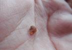 Where do warts come from and how to get rid of them